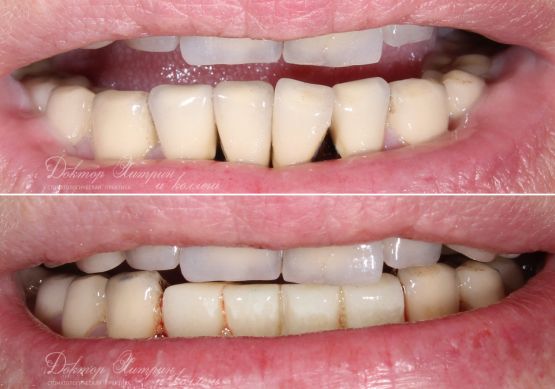 До и после: Восстановление передних зубов нижней челюсти