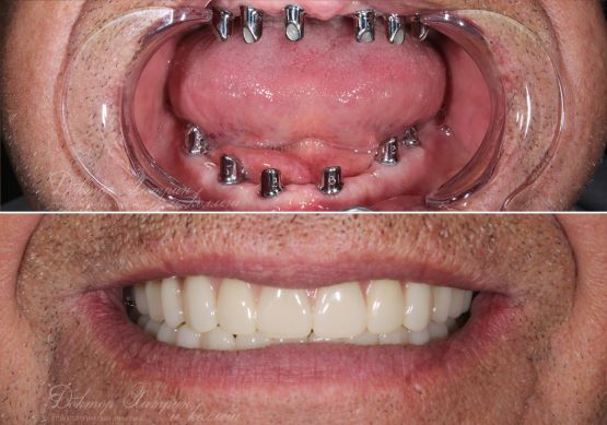 До и после: Обе челюсти All-on-6‎