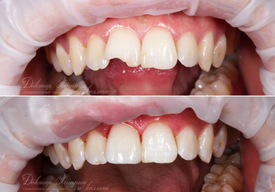 До и после: Терапевтический винир