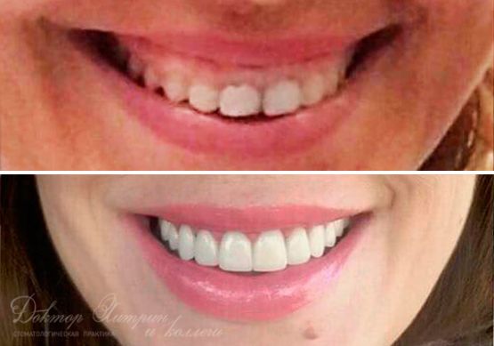 До и после: Виниры