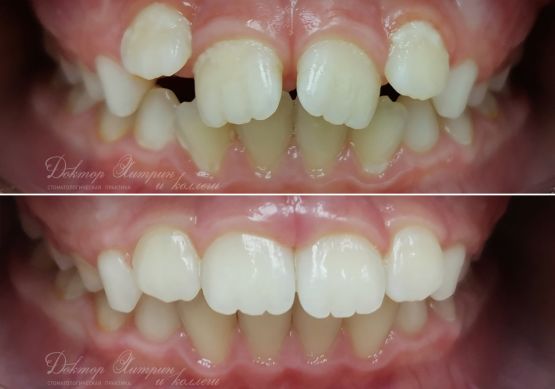 До и после: Детская брекет-система 2x4