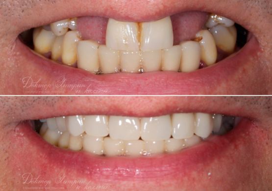 До и после: Верхняя челюсть<br>«‎All-on-4»