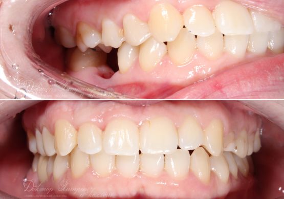 До и после: Восстановление жевательного зуба