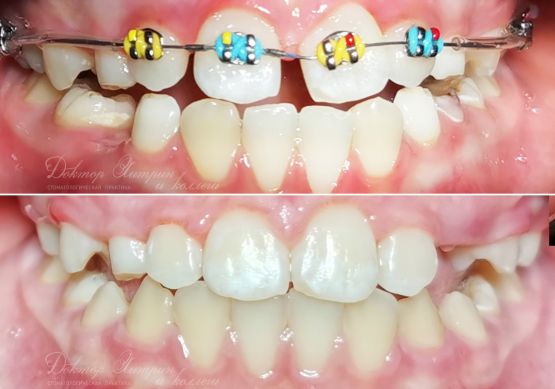 До и после: Исправление неправильного положения зубов