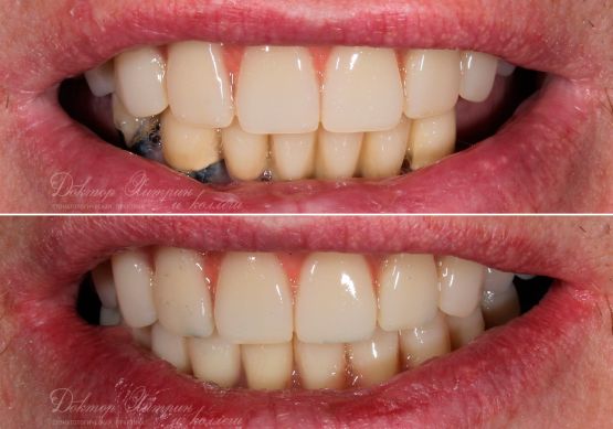 До и после: Нижняя челюсть «‎All-on-4»