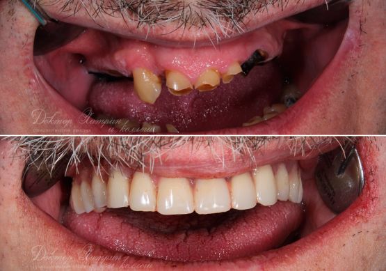 До и после: Верхняя челюсть «‎All-on-4»