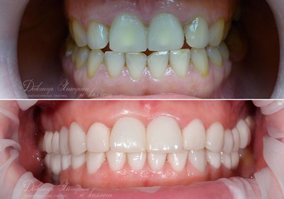 До и после: Восстановление переднего зуба