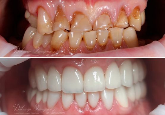 До и после: Полная реабилитация полости рта