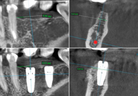 До и после: Костная пластика