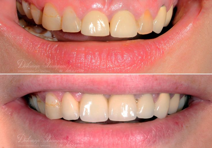 До и после: Восстановление передних зубов верхней челюсти