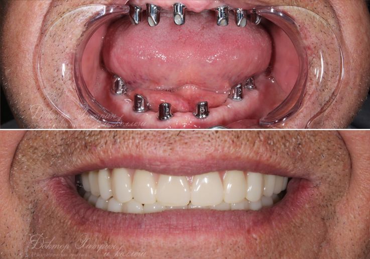 До и после: Обе челюсти All-on-6‎