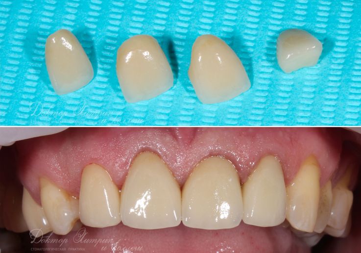 До и после: Виниры