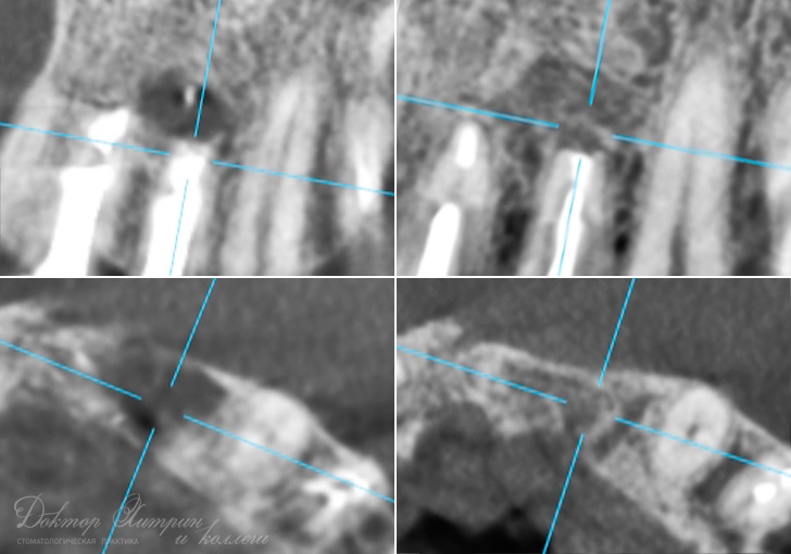 До и после: Хирургическое лечение кисты зуба До и после: Хирургическое лечение кисты зуба