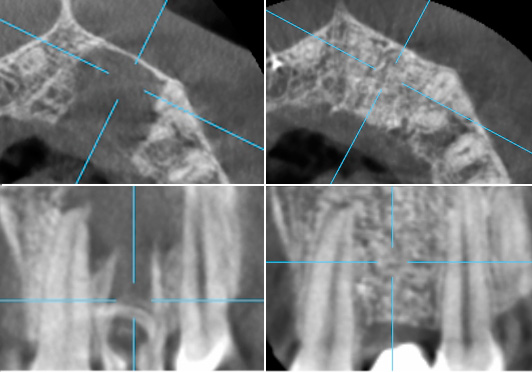 До и после: Лечение кисты зуба