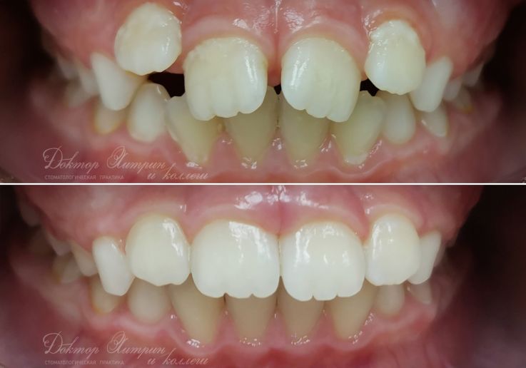 До и после: Детская брекет-система 2x4