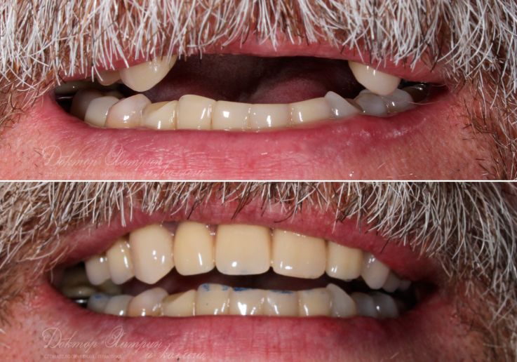 До и после: Верхняя челюсть<br>«‎All-on-4»