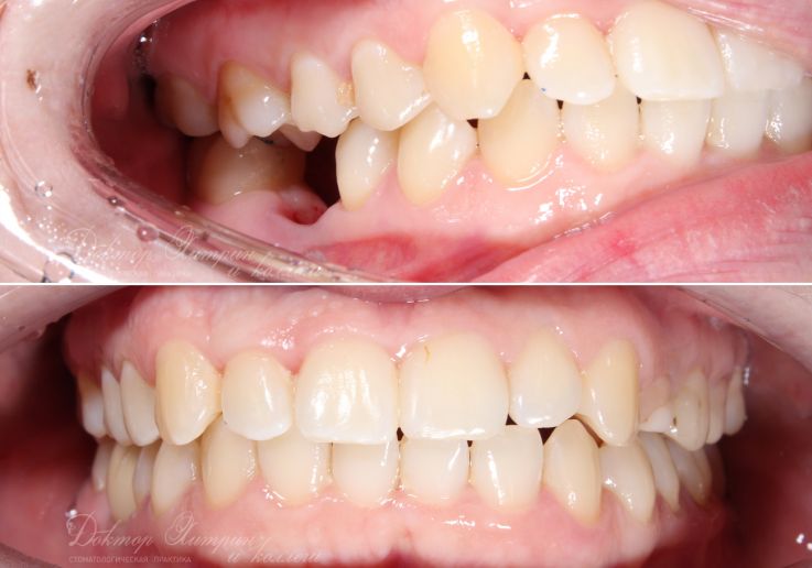До и после: Восстановление жевательного зуба