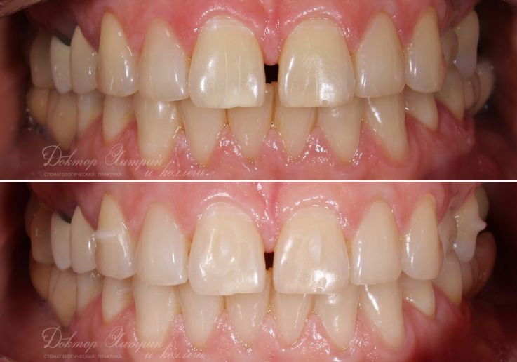 До и после: Диастема (щель между передними зубами)