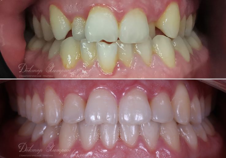 До и после: Безлигатурные брекеты