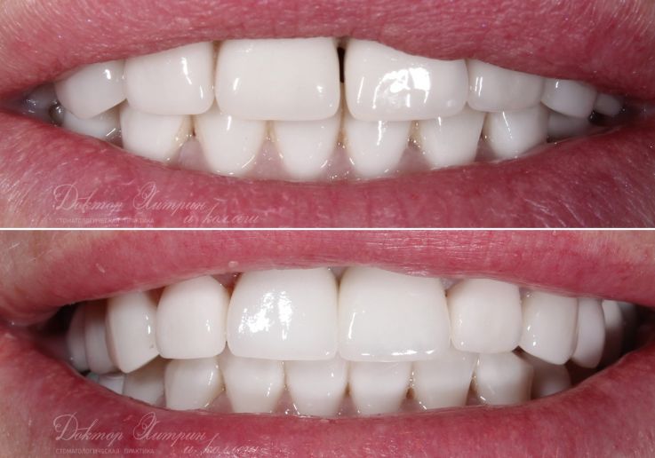 До и после: Имплантат Nobel biocare с временной коронкой